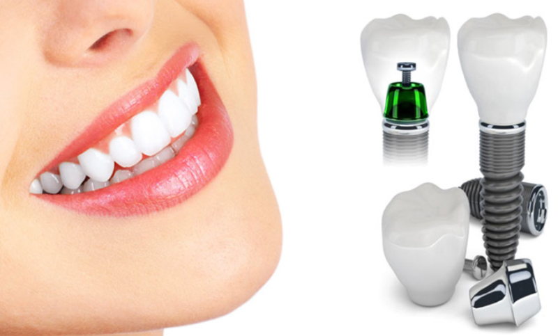 Trồng răng implant đem lại hàm răng chắc khỏe và đẹp không thua kém gì răng thật