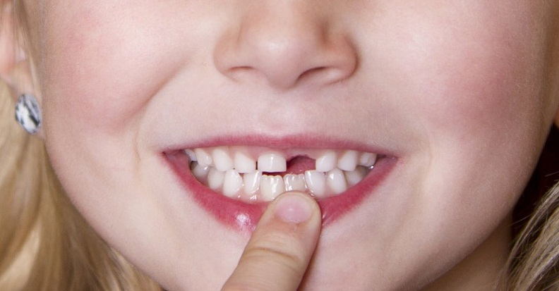 Cắm implant trồng răng cửa tốn bao nhiêu tiền?