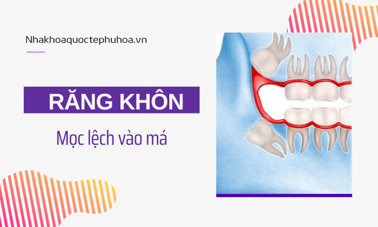 Răng khôn mọc lệch vào má nên xử lý thế nào? 1