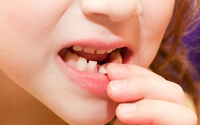 Có nên nhổ răng sữa cho trẻ khi nó mới lung lay không?