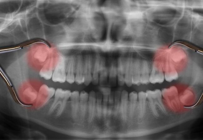 Chi phí nhổ răng khôn phụ thuộc vào số lượng răng cần nhổ