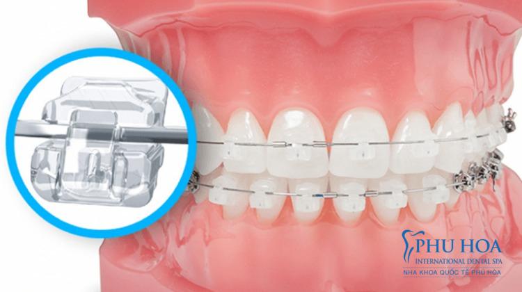 Niềng răng mắc cài sứ tự buộc có lực siết duy trì ổn định, hạn chế tình trạng bung dây cung
