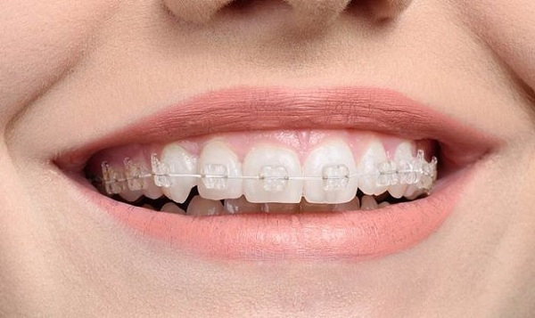 Phương pháp niềng răng mắc cài sứ tự buộc là gì