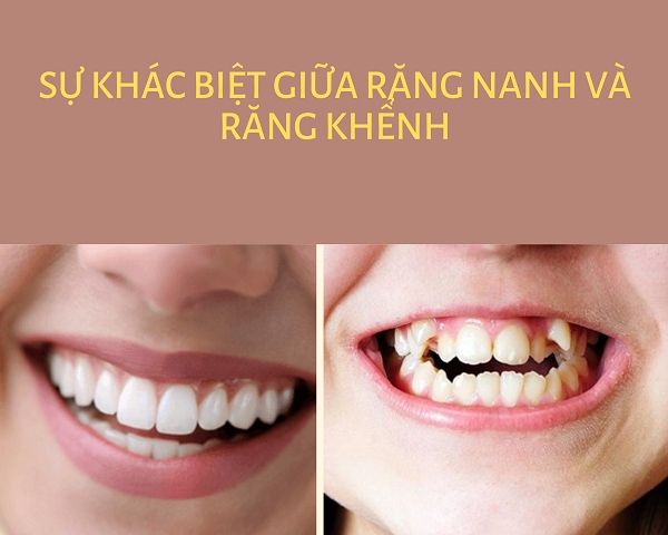 Răng nanh và răng khểnh có giống nhau không? 1
