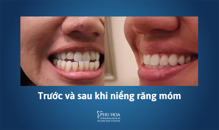 Hình ảnh trước và sau khi niềng invisalign đối với trường hợp răng móm