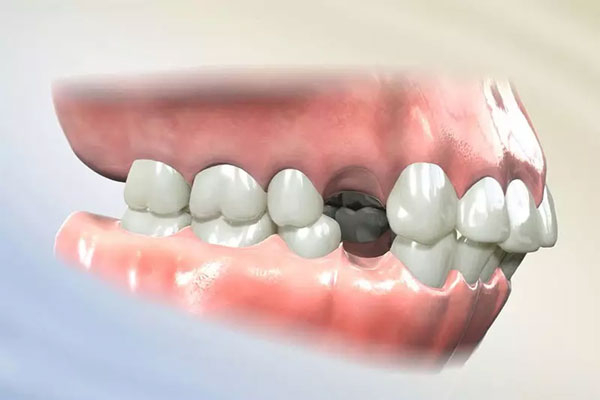 Niềng răng invisalign phải nhổ răng có ảnh hưởng gì không?