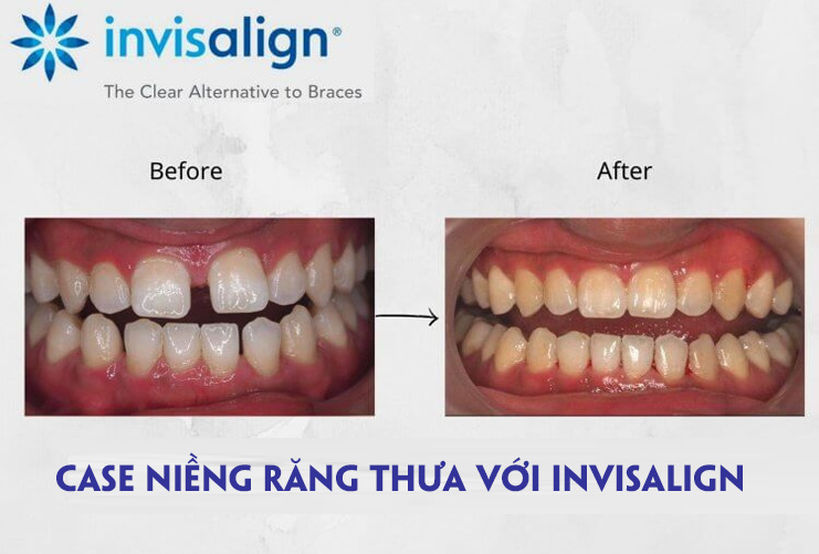 Hình ảnh trước và sau khi niềng invisalign đối với trường hợp răng thưa