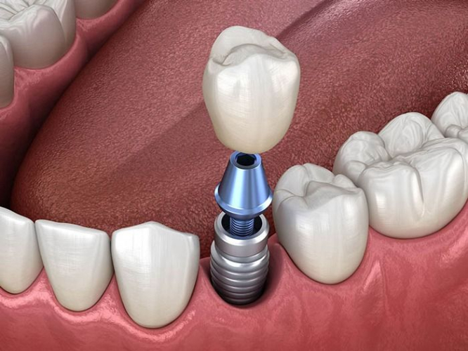 Phục hình răng sứ trên implant và hoàn tất quá trình trồng răng