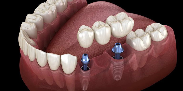 Tìm hiểu trồng răng implant là phương pháp gì?