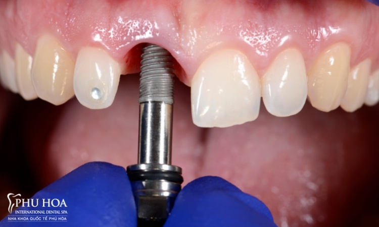 Quá trình trồng răng implant có đau không