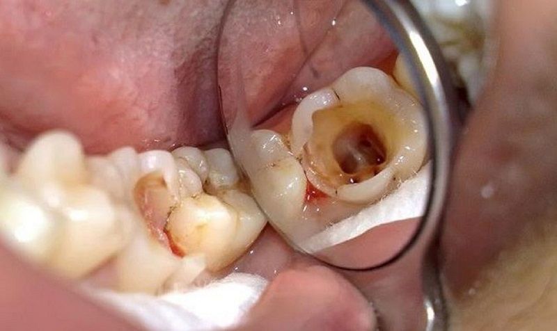 Hàn răng có đau không? Những lưu ý cần biết sau hàn răng? 4 cac-yeu-to-anh-huong-den-cam-giac-dau-sau-han-rang