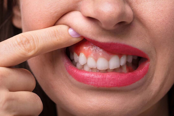 Hàn răng có đau không? Những lưu ý cần biết sau hàn răng? 2 kich-ung-mo-rang