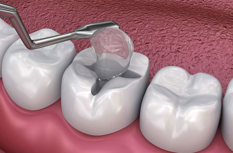 Hàn răng có đau không? Những lưu ý cần biết sau hàn răng? 3 vat-lieu-han