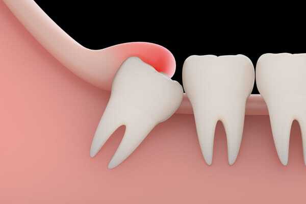 Tại sao mọc răng khôn lại đau? 1