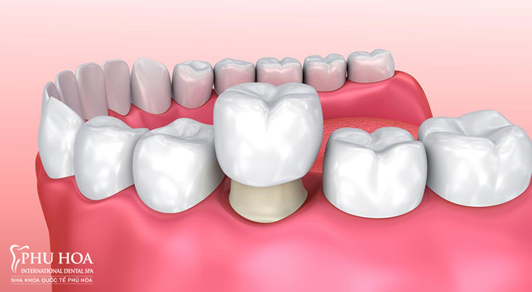 Thế nào là bọc răng sứ cercon? 1