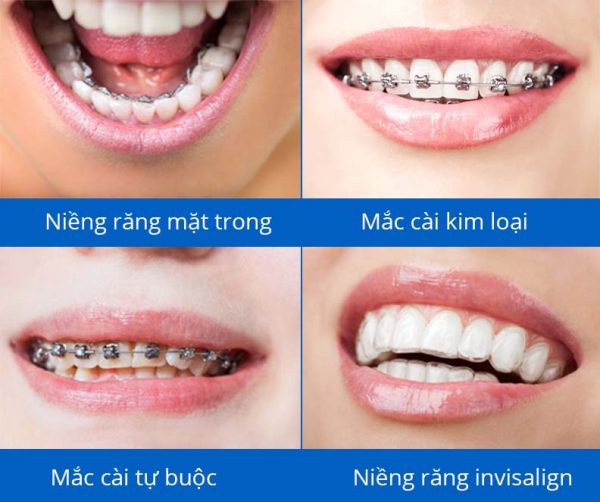 Sơ lược về các phương pháp niềng răng? 1