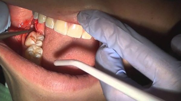 Nhổ răng ảnh hưởng gì không, biến chứng không? 1