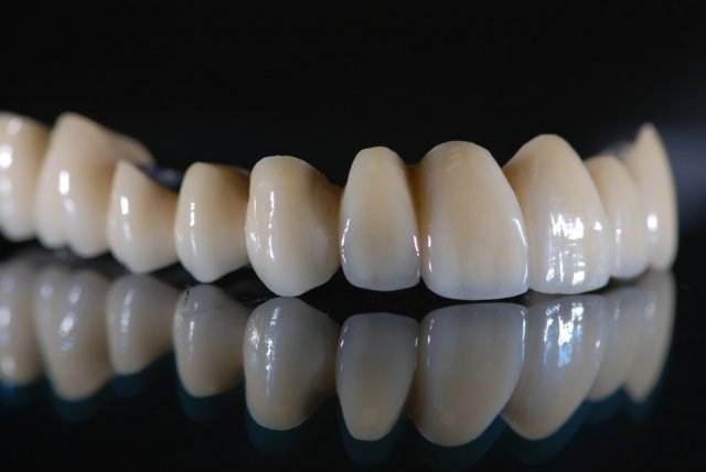 Răng sứ từ titan 1
