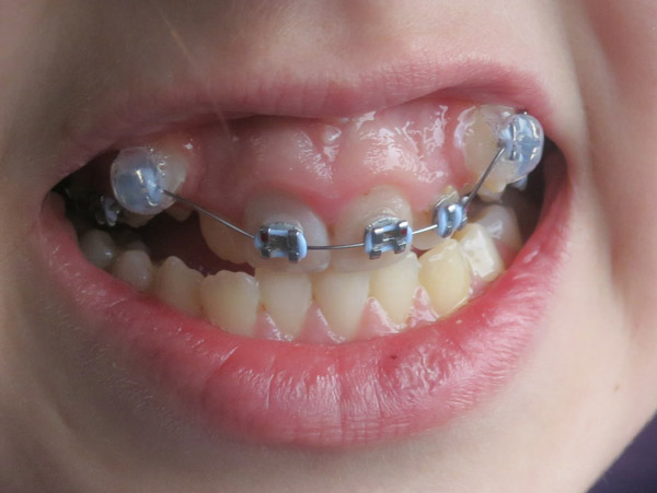 Không chỉnh răng khấp khểnh có tác hại thế nào tới sức khỏe nha chu 1