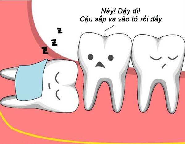 Răng khôn rất thích những chiếc răng khác? 2