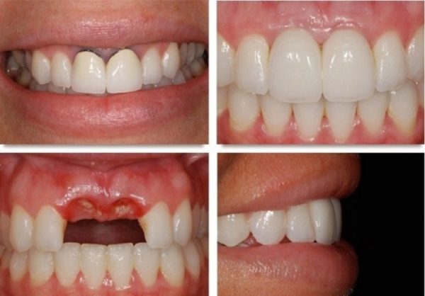 trước và sau khi làm cầu răng sứ