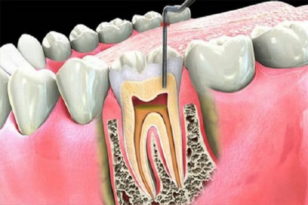 1. Điều trị tủy răng là gì? 1