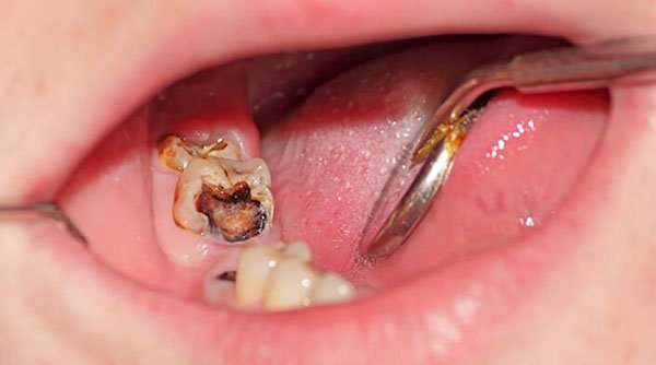 Nguyên nhân, dấu hiệu và tác hại của tình trạng răng hàm sâu? 1