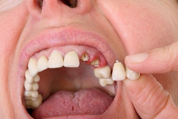 Bọc răng sứ là gì? Bọc răng sứ có tốt không?
