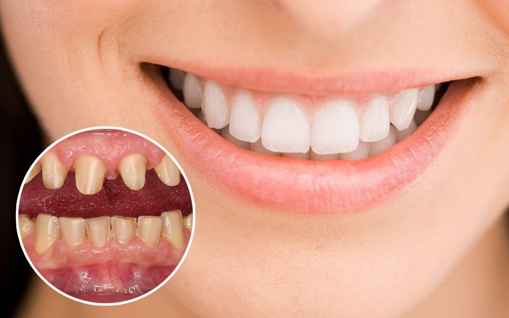 Bọc răng sứ có phải nhổ răng không? 1