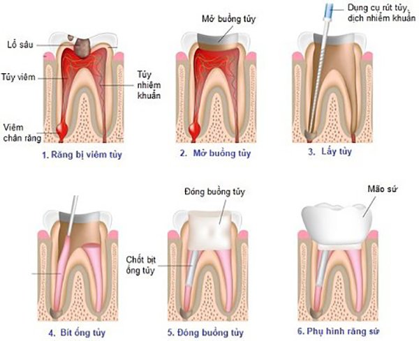 Phương pháp lấy tủy răng khôn 1