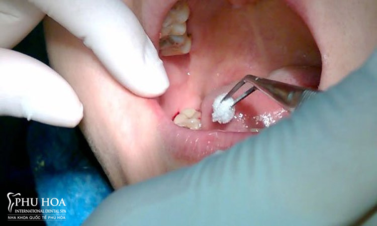 Chi phí nhổ răng khôn bị sâu tại Nha khoa 1