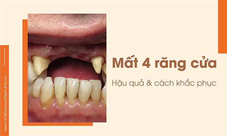 Bị mất 4 răng cửa nên làm gì để khắc phục?