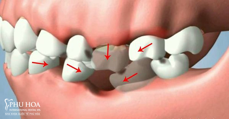 Mất răng số 7 có ảnh hưởng gì? 2