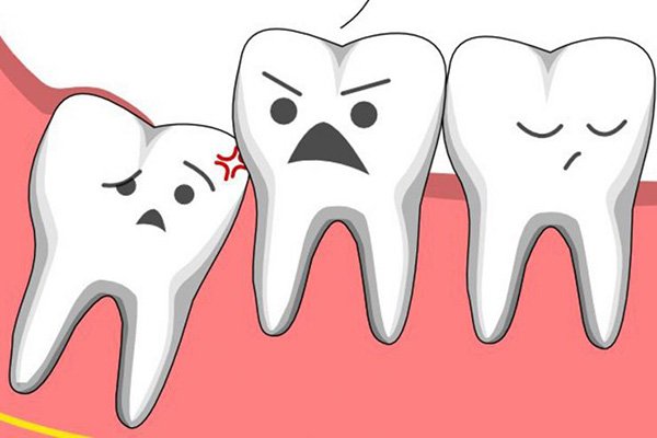 Răng như thế nào mới cần nhổ? 1