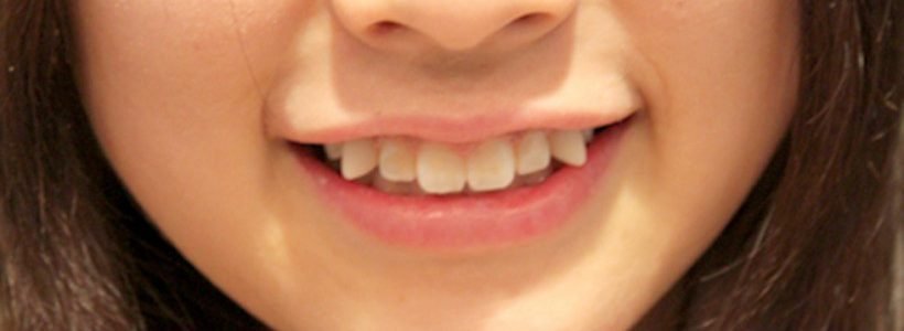 Răng khểnh và những điều cần biết 1