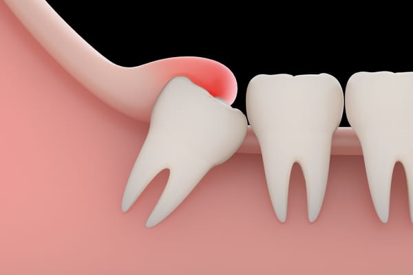 Các yếu tố ảnh hưởng đến việc nhổ răng khôn bao lâu thì lành 1