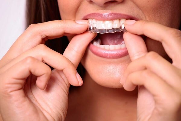niềng răng Invisalign 1 hàm