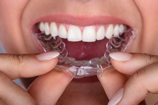 Răng hàm khấp khểnh cần niềng răng Invisalign 1 hàm
