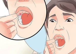 quá trình hồi phục sau khi nhổ răng khôn