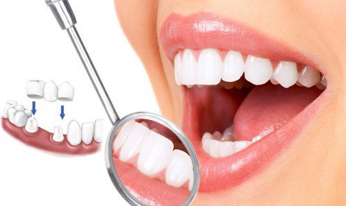 Quy trình làm cầu răng sứ 1