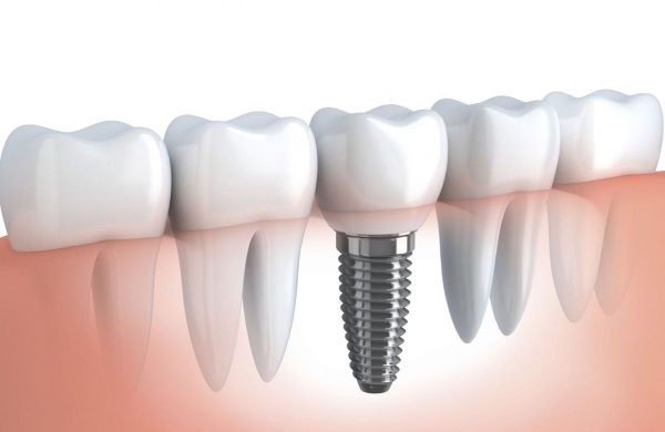 Người bệnh nên trồng răng implant sau khi nhổ