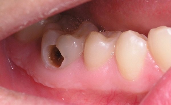 Răng sâu độ 3 có xuất hiện lỗ hỏng