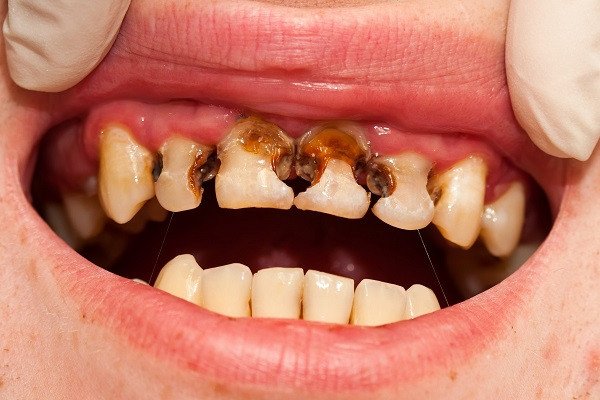 Nguyên nhân khiến răng sữa trẻ em bị sâu