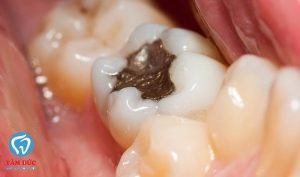 1. Trám răng bằng vật liệu Composite 2