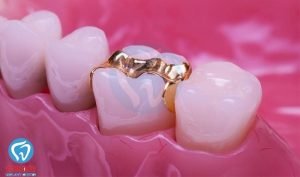 3. Trám răng bằng vật liệu vàng và quý kim 1