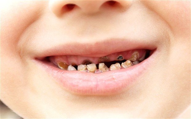 Nguyên nhân gây sâu răng ở trẻ em 1
