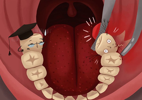 Những triệu chứng sau nhổ răng thường gặp 1