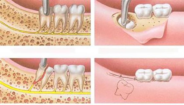 Tại sao lại có sự khác biệt về chi phí nhổ răng khôn hàm trên, hàm dưới? 1