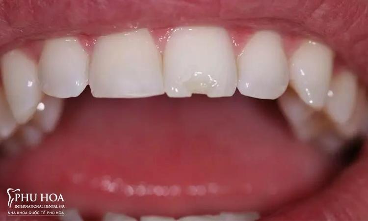 3.2. Tác động xấu tới răng và men răng 1