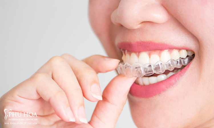 1. Giới thiệu về phương pháp niềng răng trong suốt không mắc cài 1